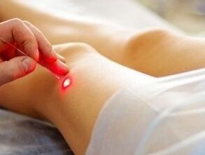 Θεραπεία της αρθρθετρώσης της άρθρωσης του γόνατος με λέιζερ